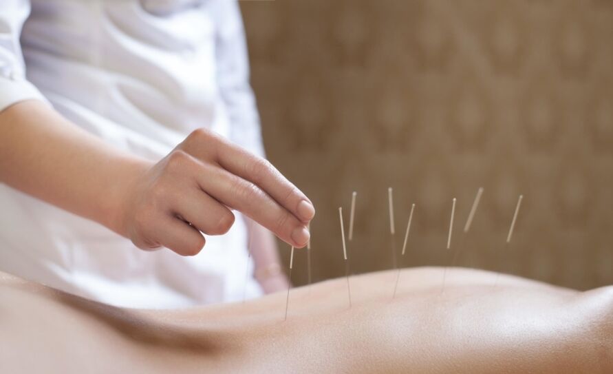 acupuntura