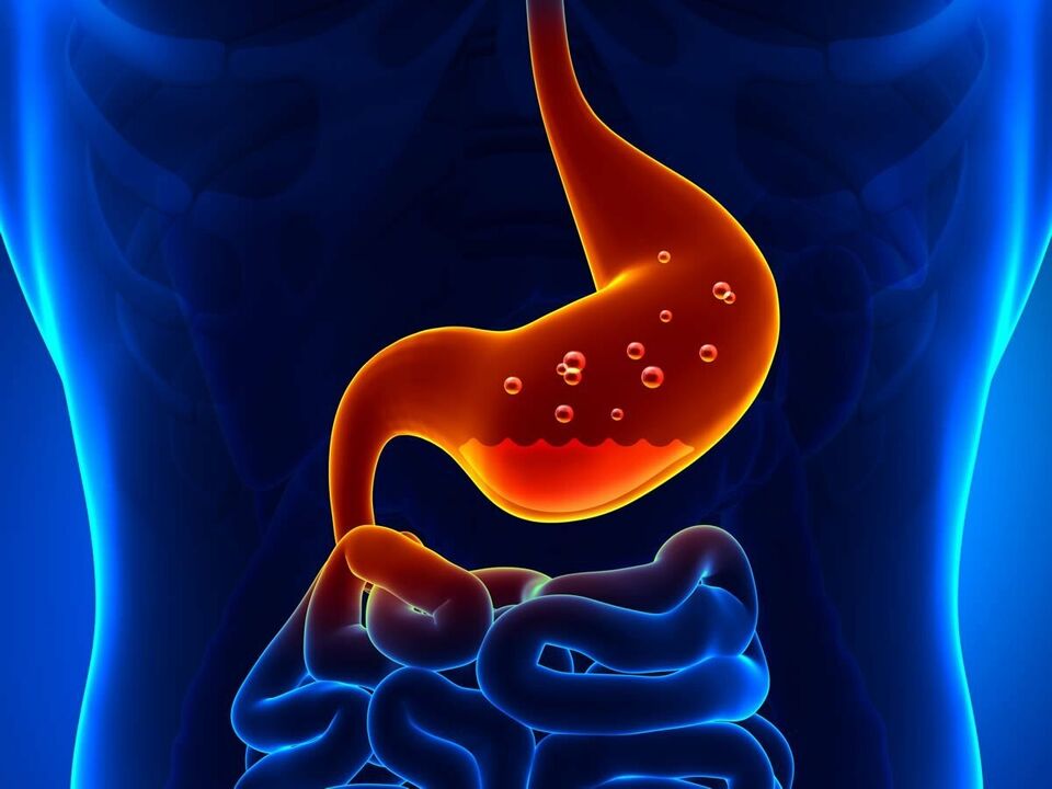 A gastrite é uma doença inflamatória do estômago que requer dieta